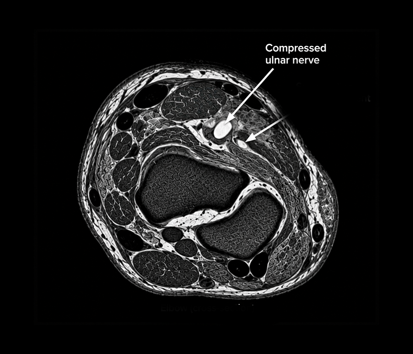 Peripheral Nerve Compression