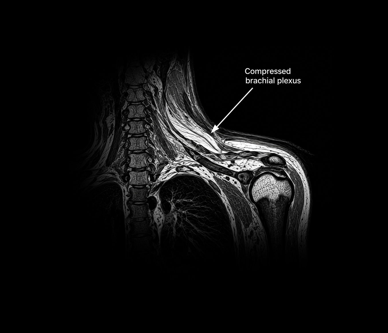 Brachial Plexus Disorders