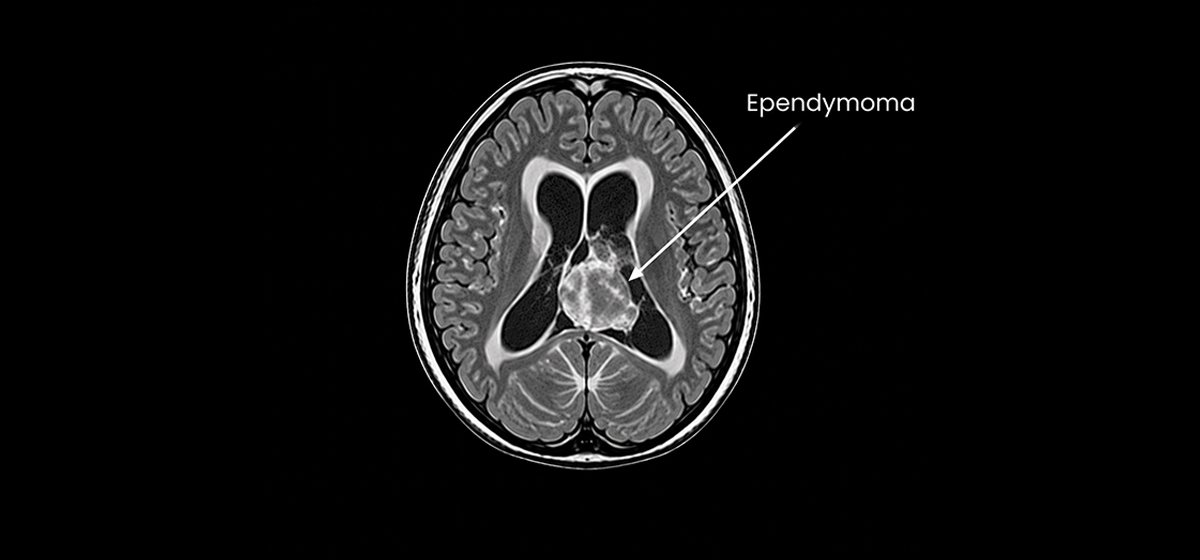 Ependymoma
