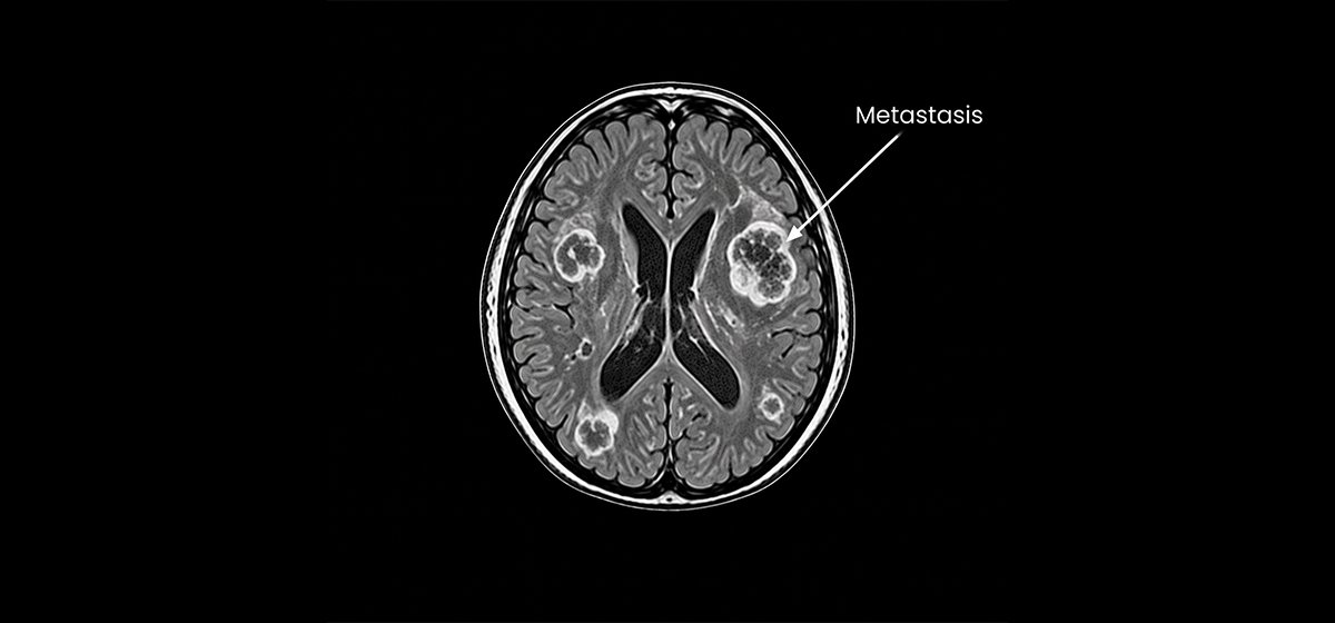 Brain Metastasis