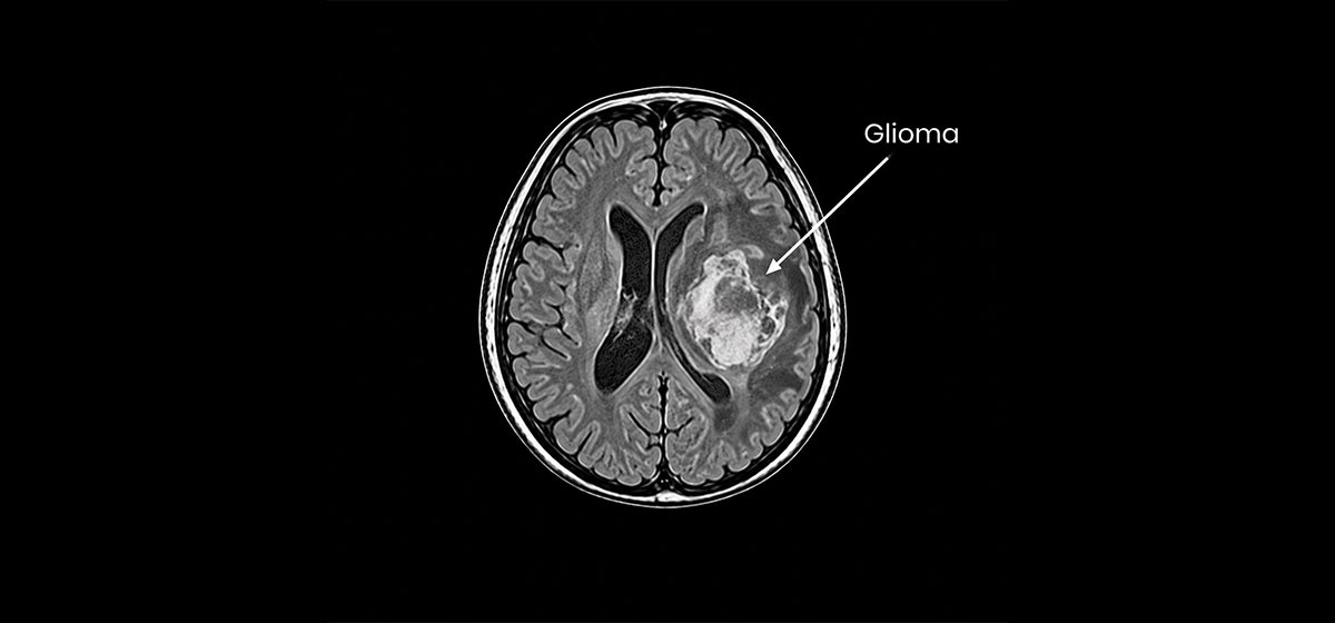 Glioma