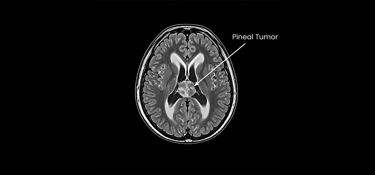 Pineal Tumor