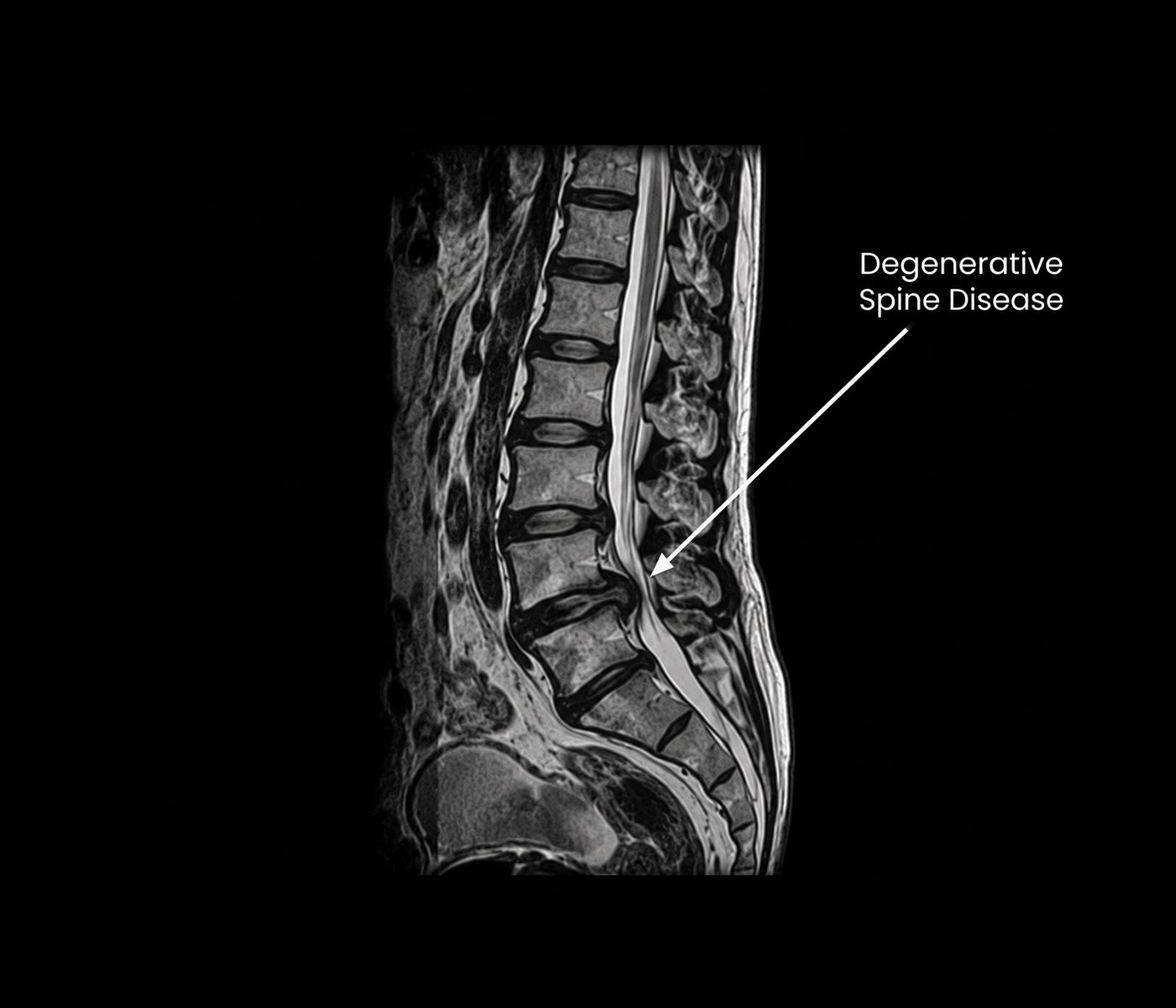 Degenerative Spine Disease