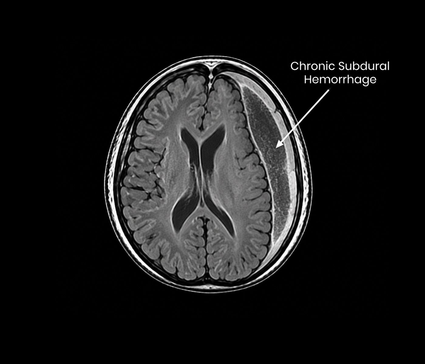 Chronic Subdural Hemorrhage