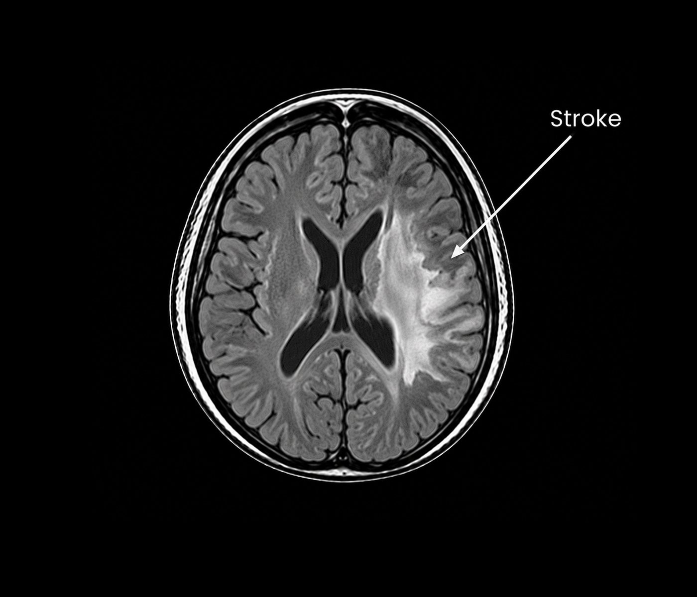 Stroke