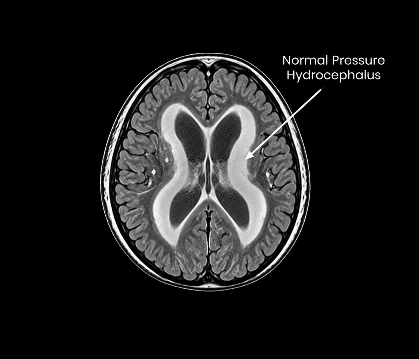 Normal Pressure Hydrocephalus