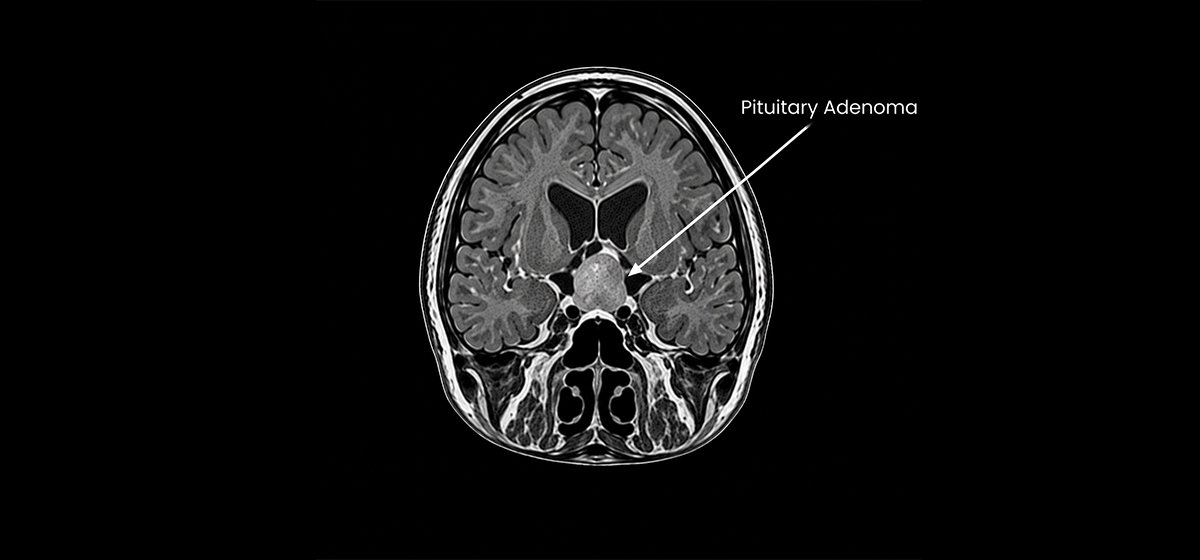 Pituitary Adenoma