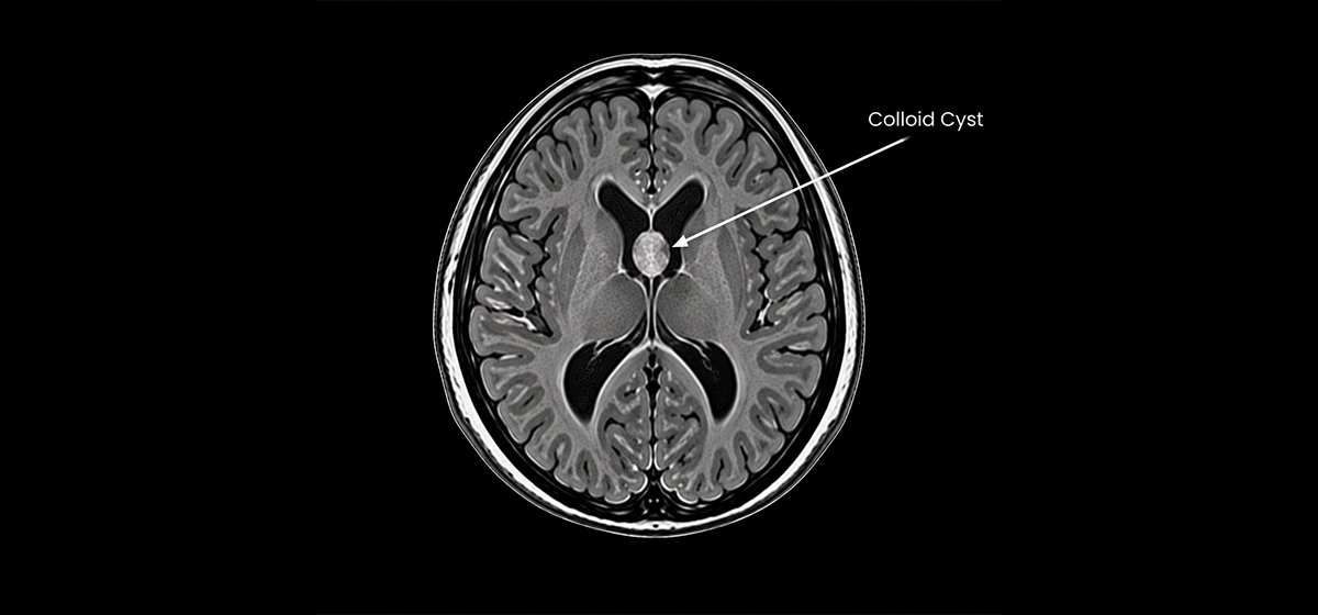 Colloid Cyst