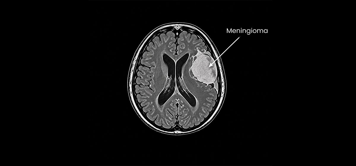 Meningioma