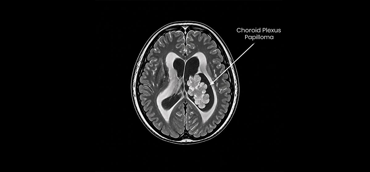 Choroid Plexus Papilloma