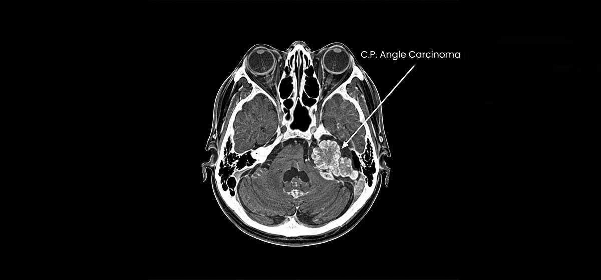Cerebellopontine Angle Carcinoma