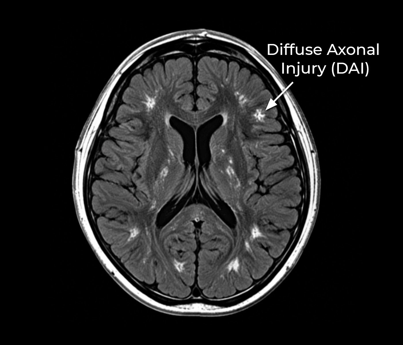 Diffuse Axonal Injury