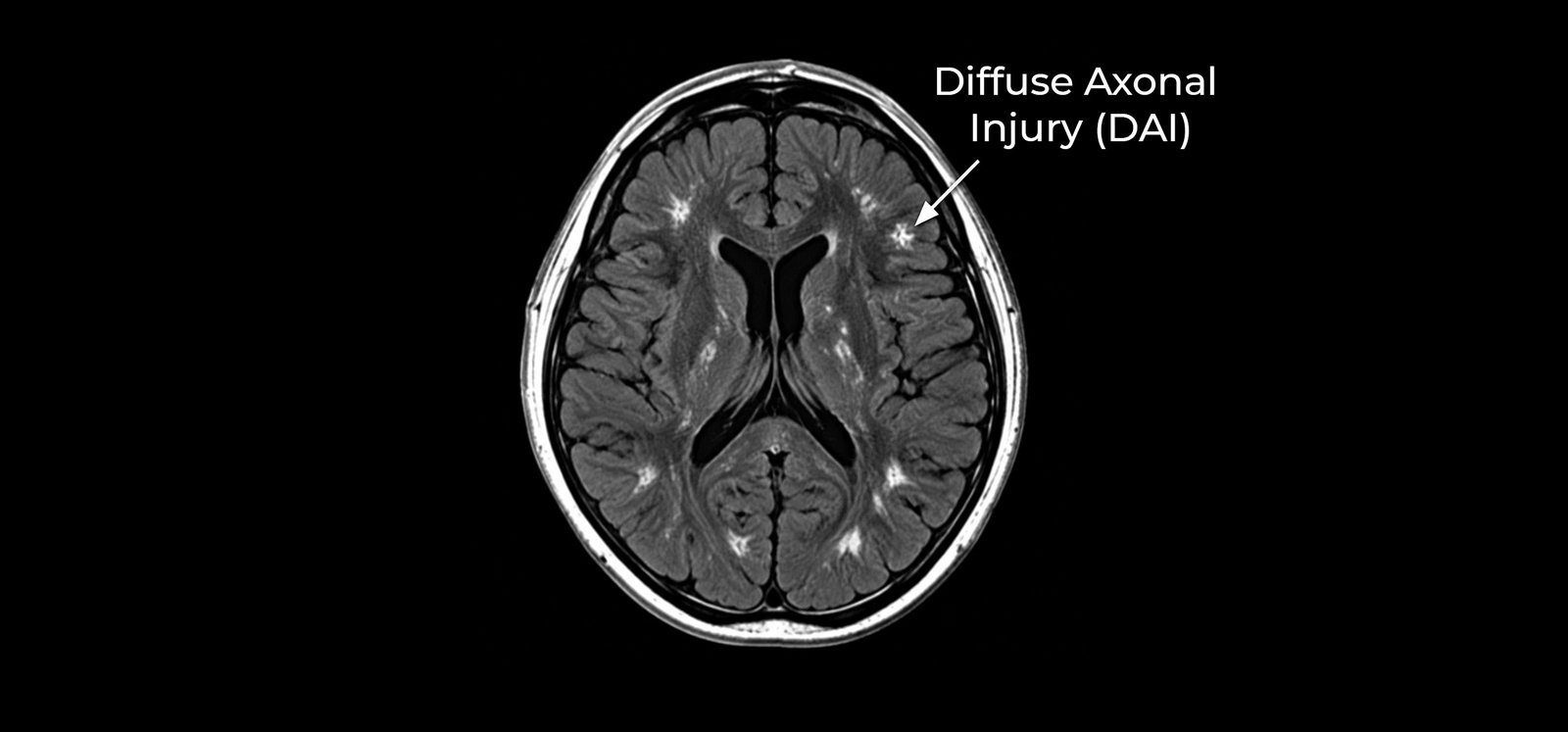 Diffuse Axonal Injury