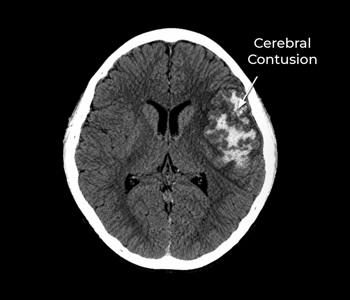Head Injuries