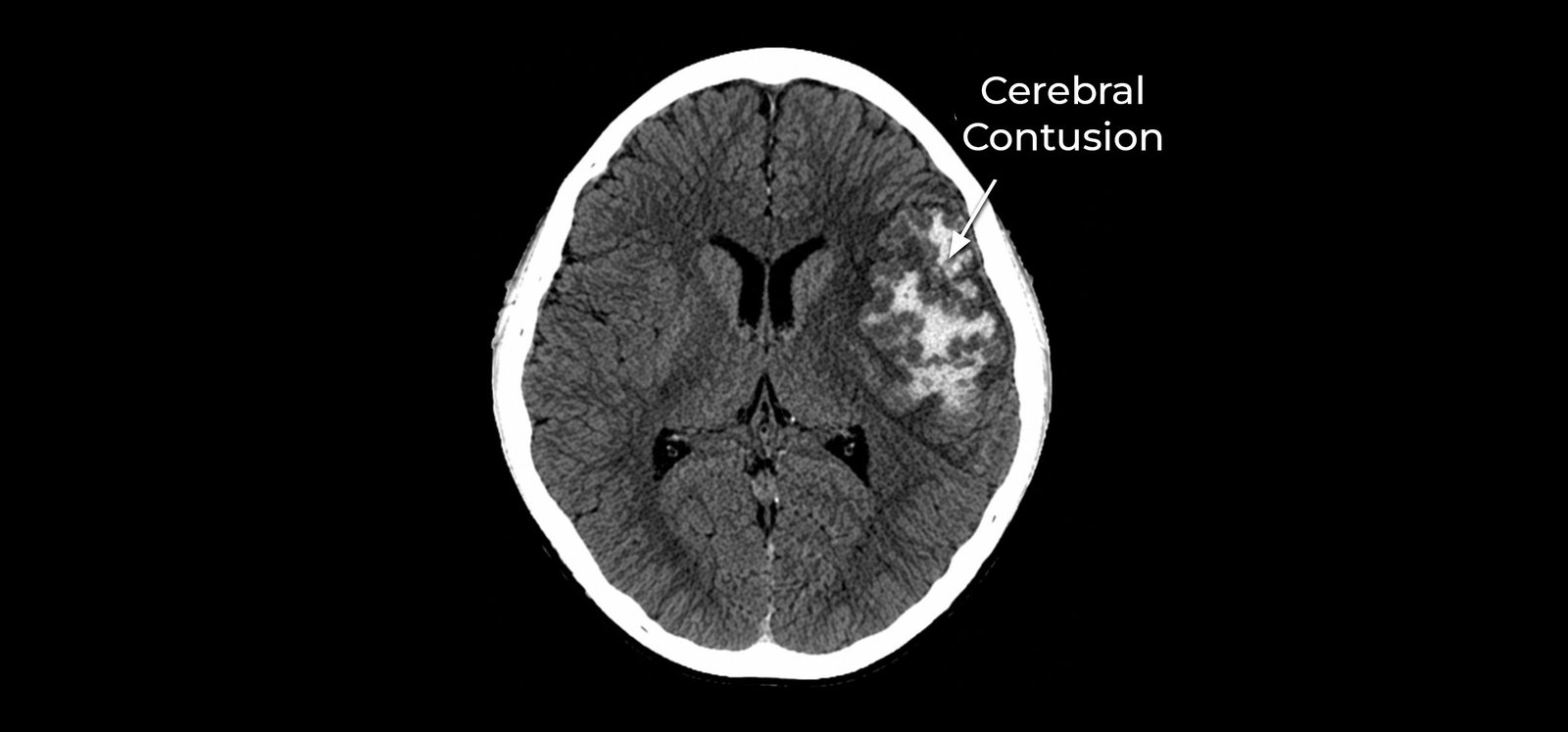 Head Injuries