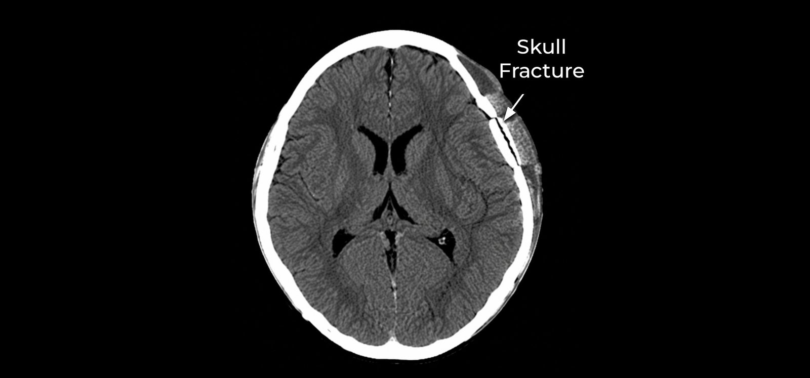 Skull Fractures