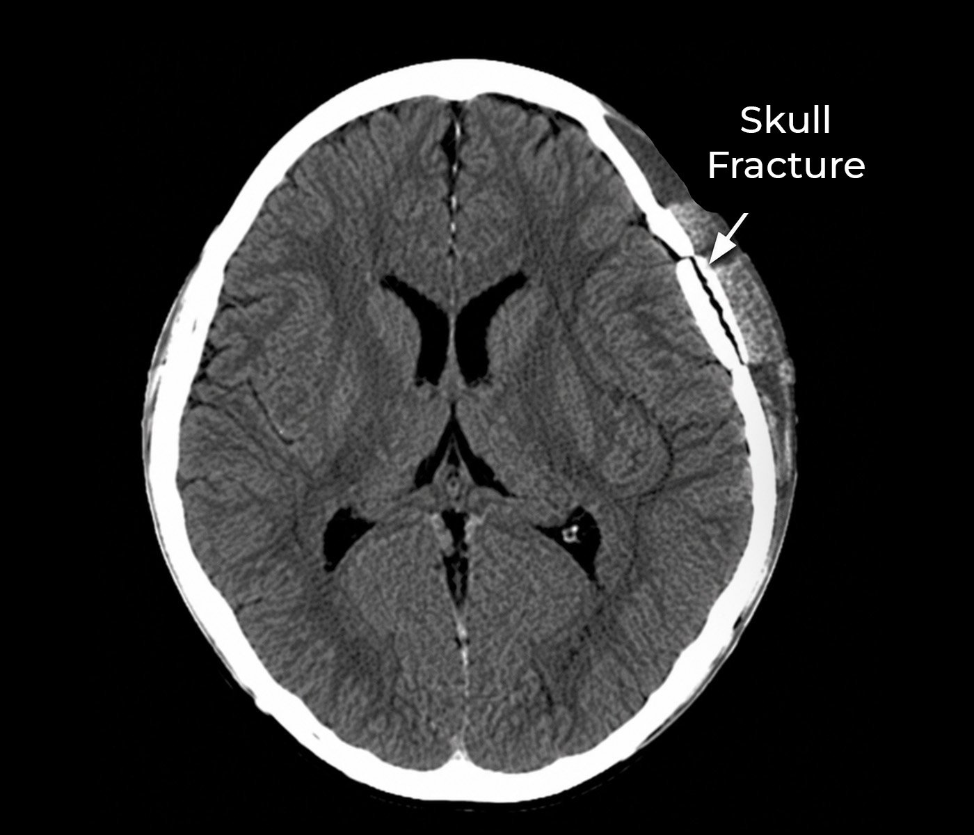 Skull Fractures