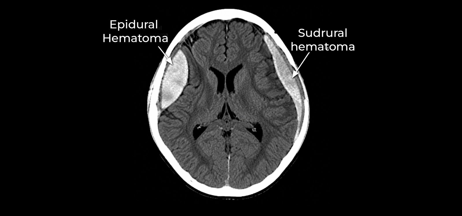 Epidural and Subdural Hematomas