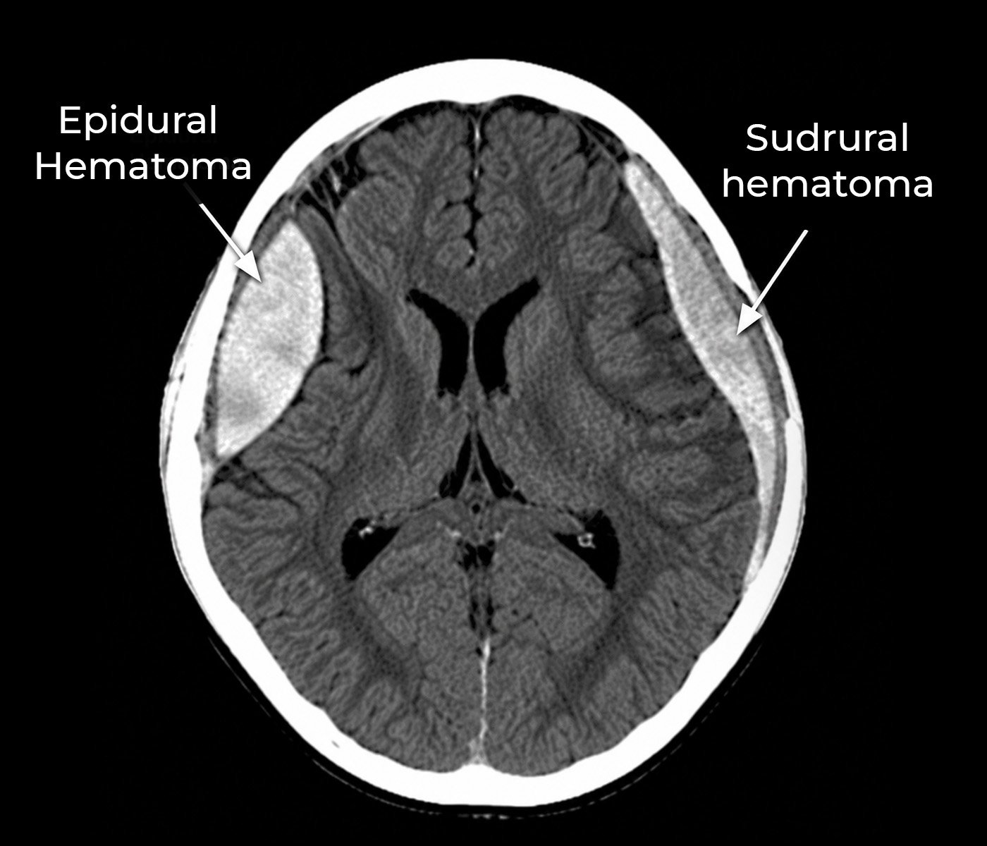 Epidural and Subdural Hematomas