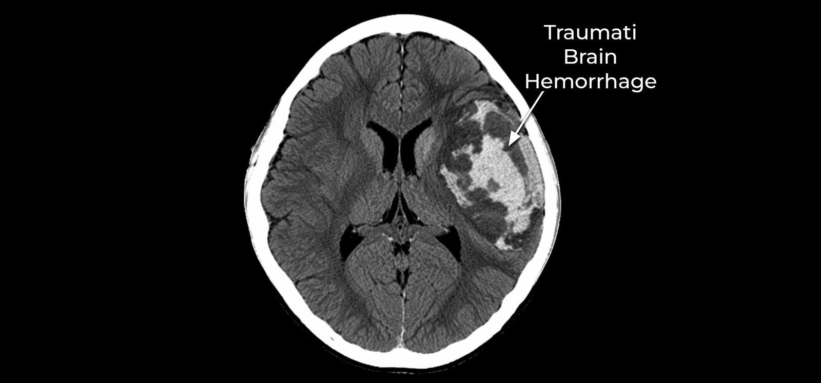 Traumatic Brain Hemorrhage
