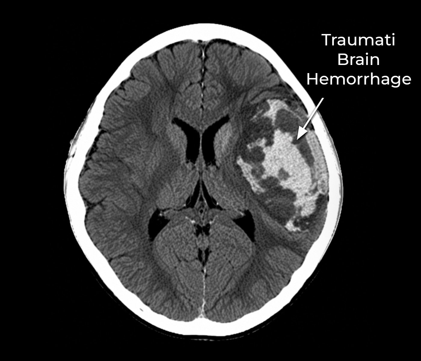 Traumatic Brain Hemorrhage