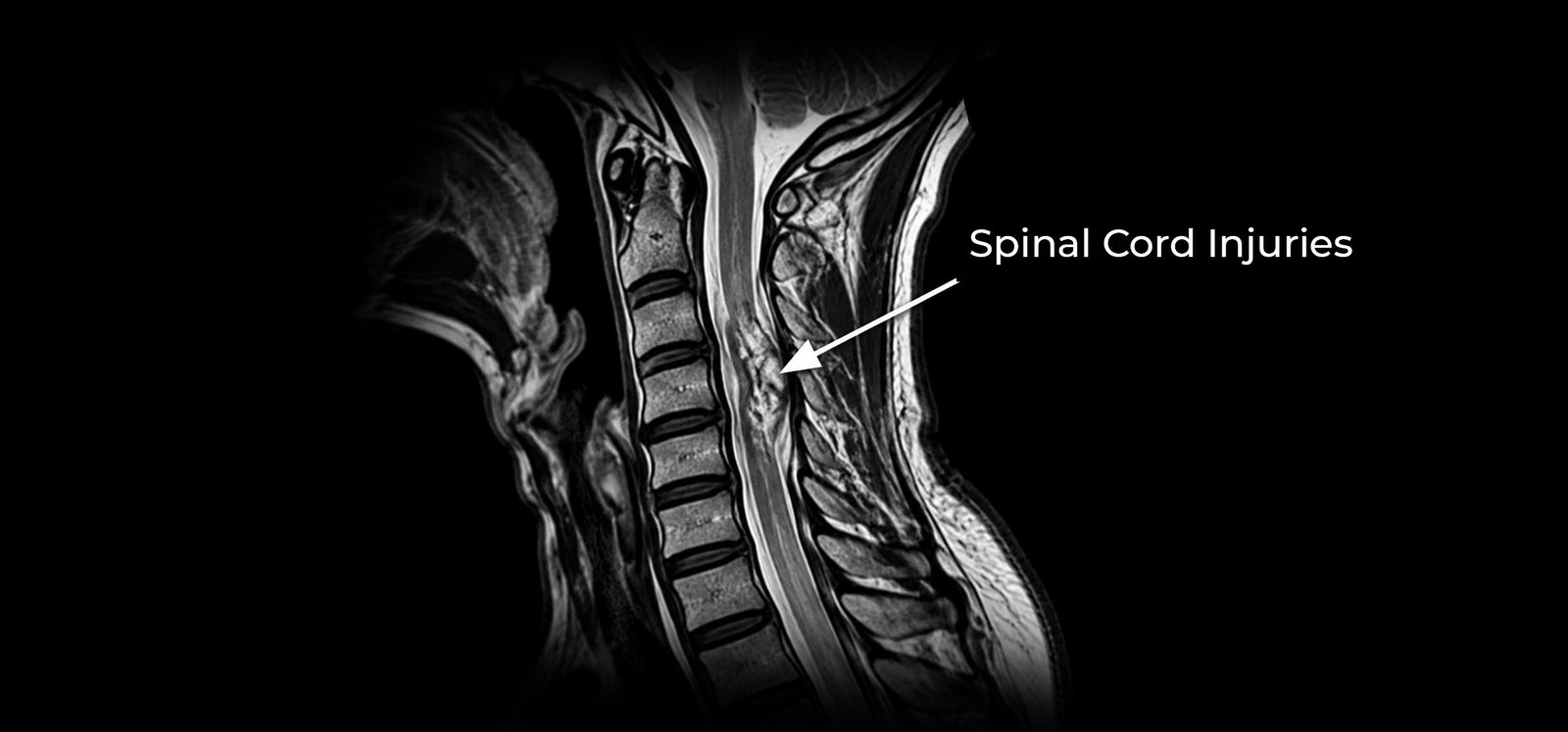 Spinal Cord Injuries