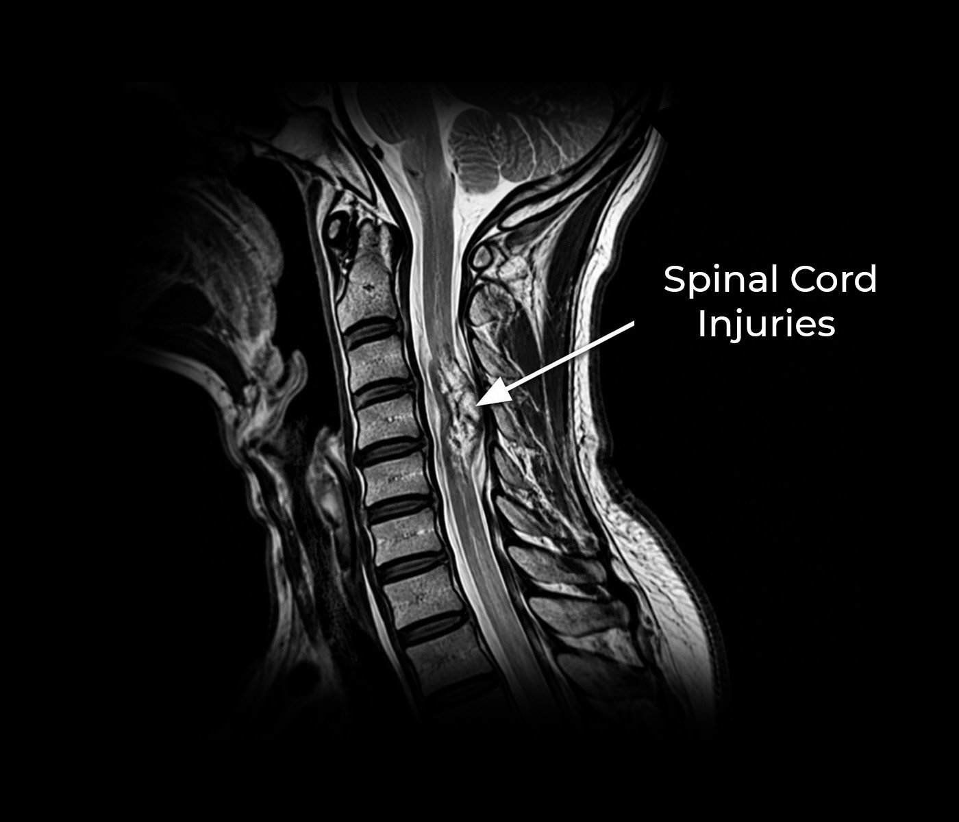 Spinal Cord Injuries