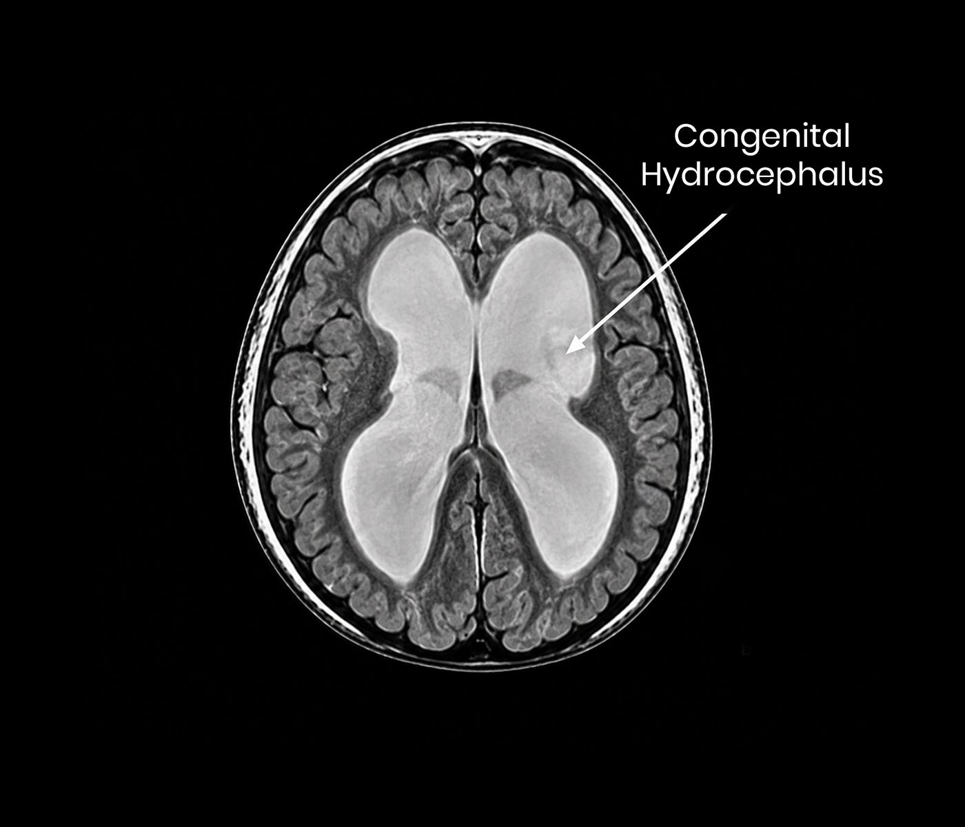 Congenital Hydrocephalus
