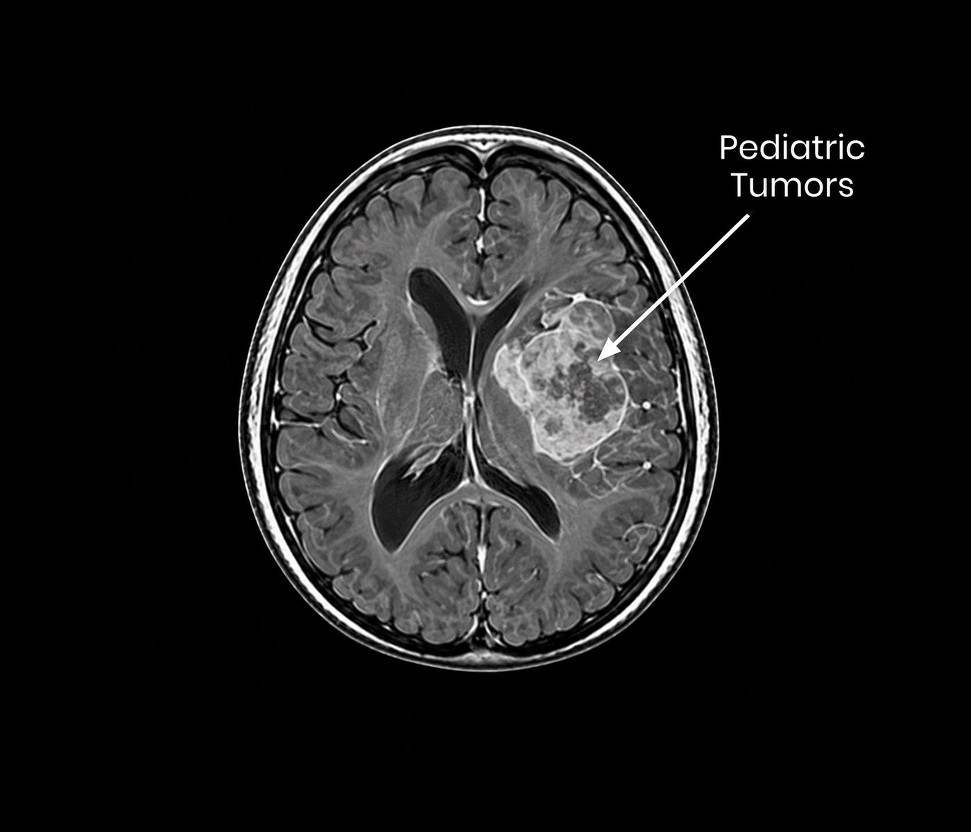 Pediatric Tumors