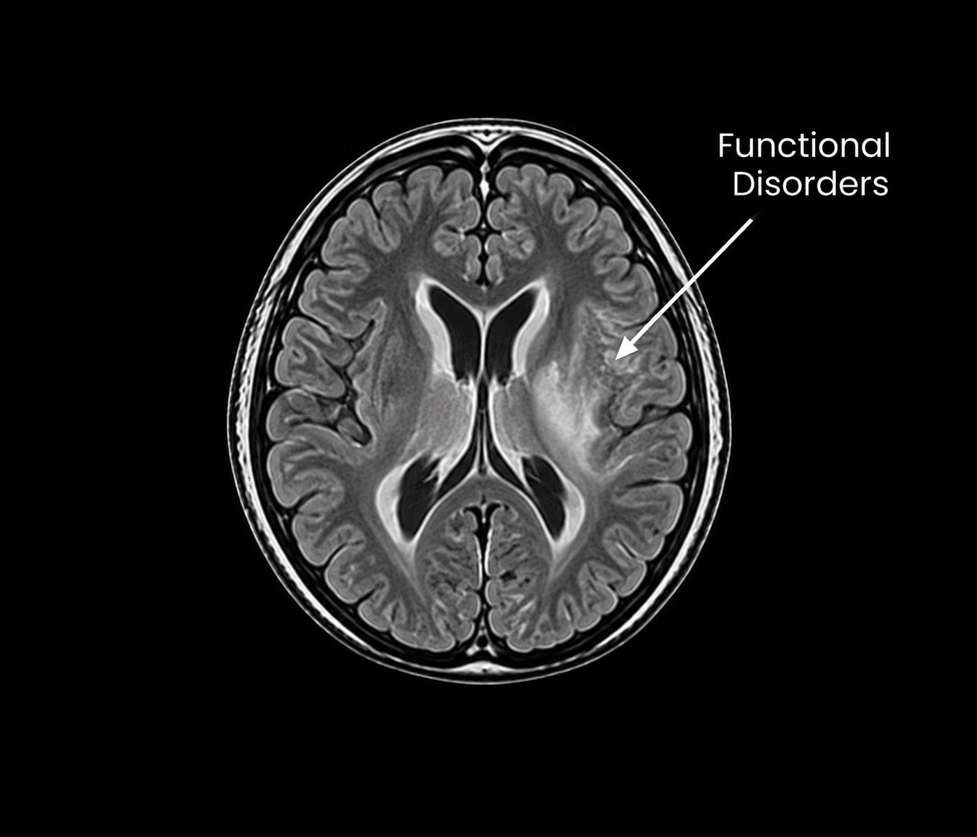 Functional Disorders and Cerebral Palsy