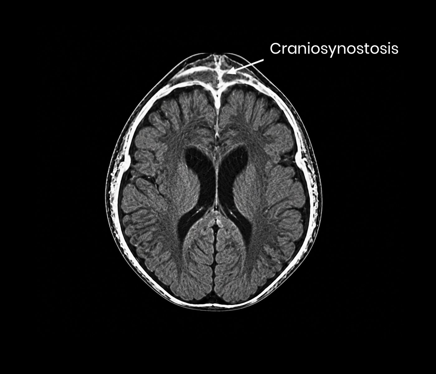 Craniosynostosis