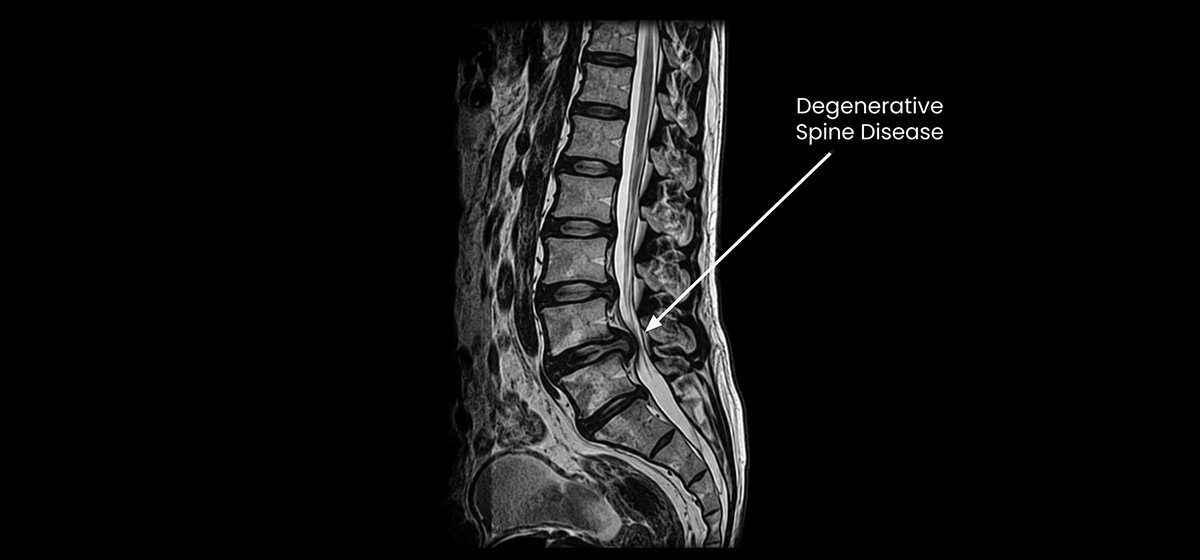 Degenerative Spine Disease