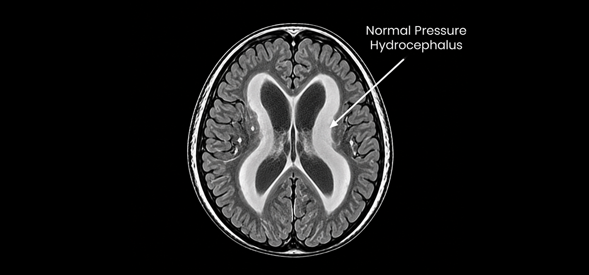 Normal Pressure Hydrocephalus