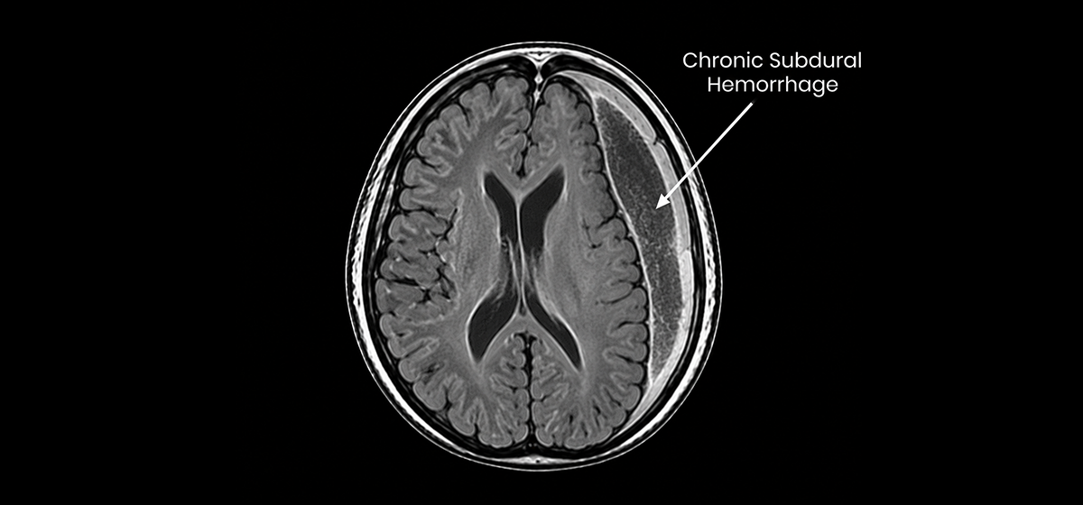 Chronic Subdural Hemorrhage