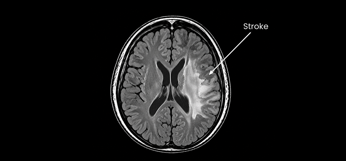Stroke