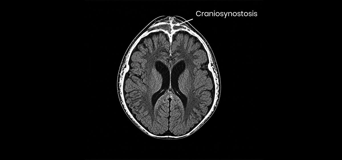 Craniosynostosis