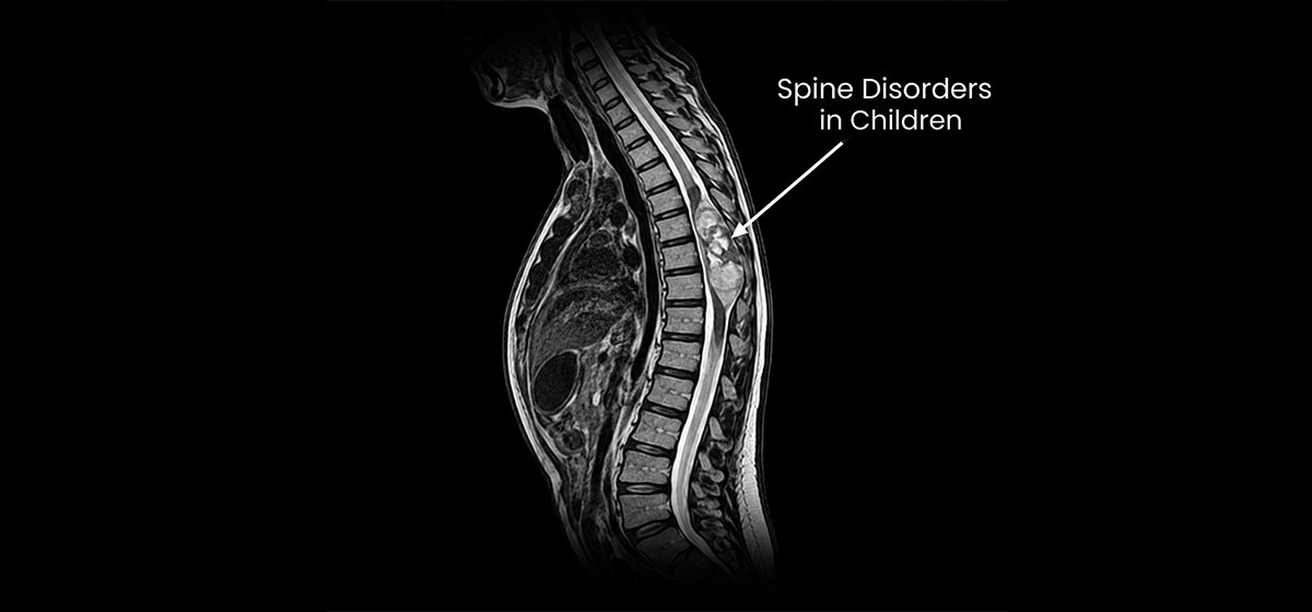 Spine Disorders in Children