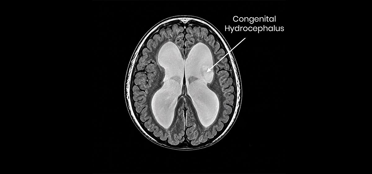 Congenital Hydrocephalus