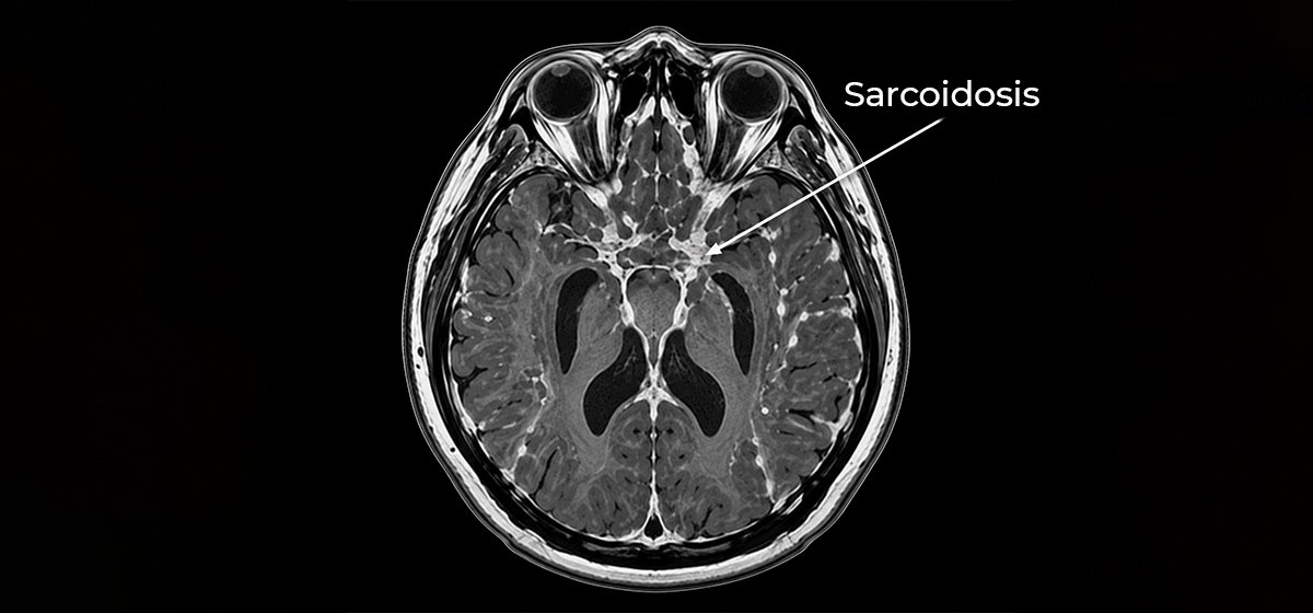 Sarcoidosis