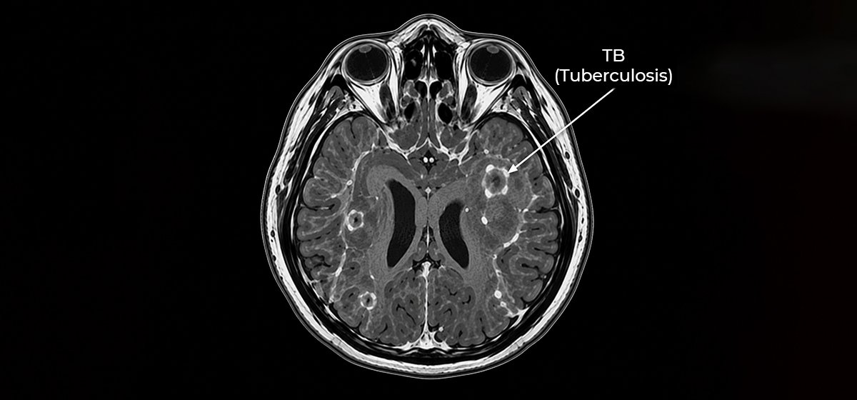 TB Tuberculosis