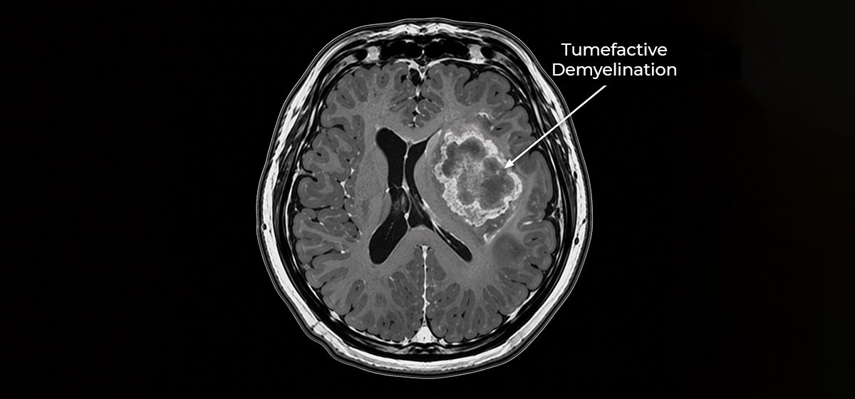 Tumefactive Demyelination