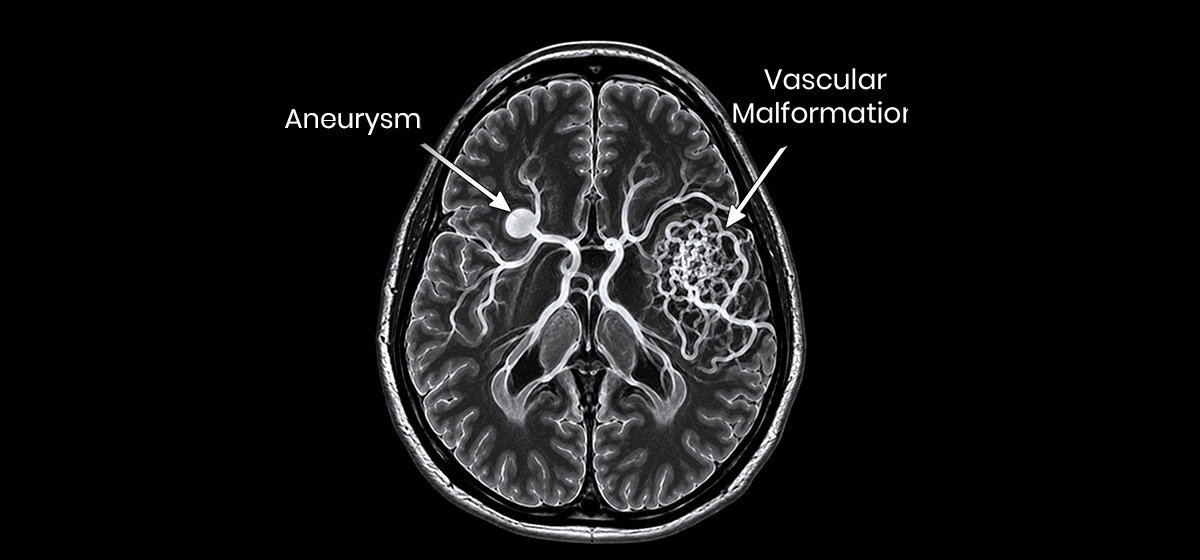 Aneurysm and Vascular Malformation