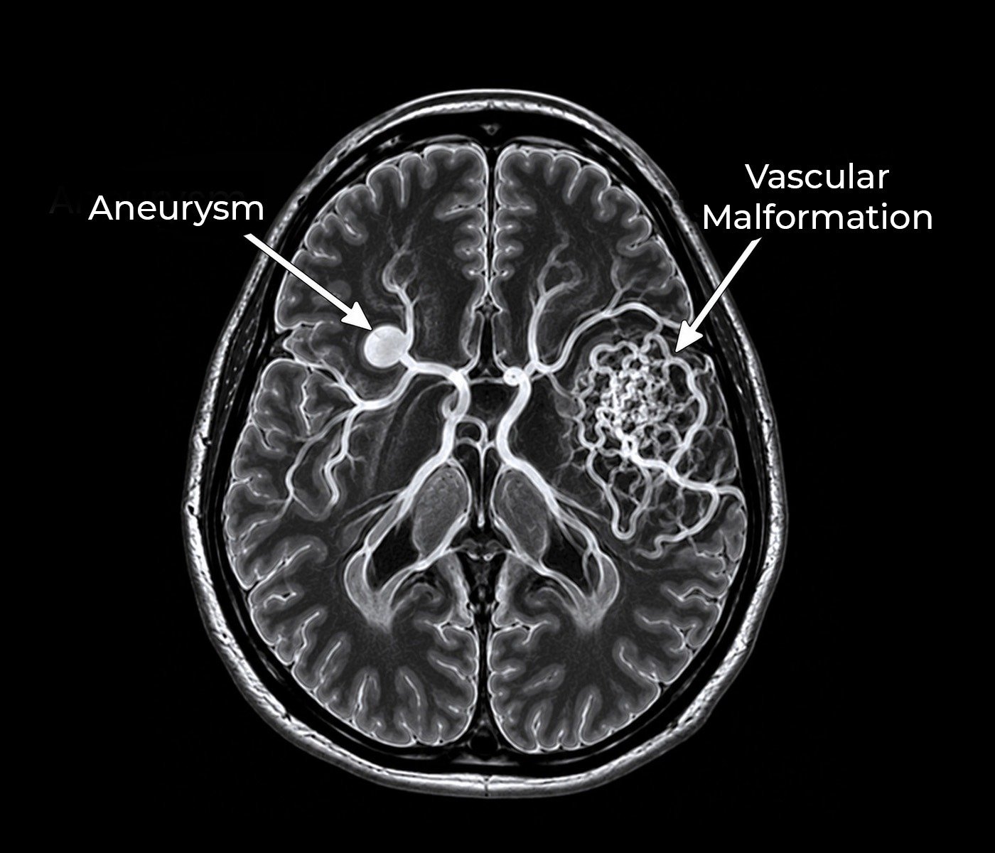 Aneurysm and Vascular Malformation
