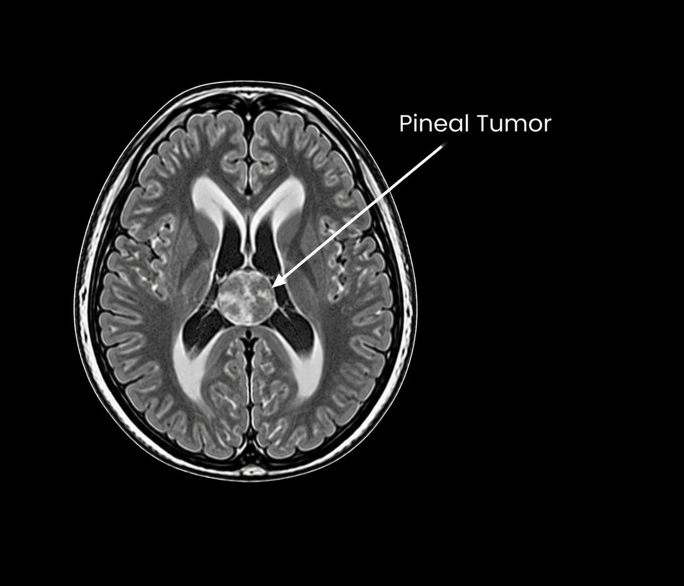 Pineal Tumor