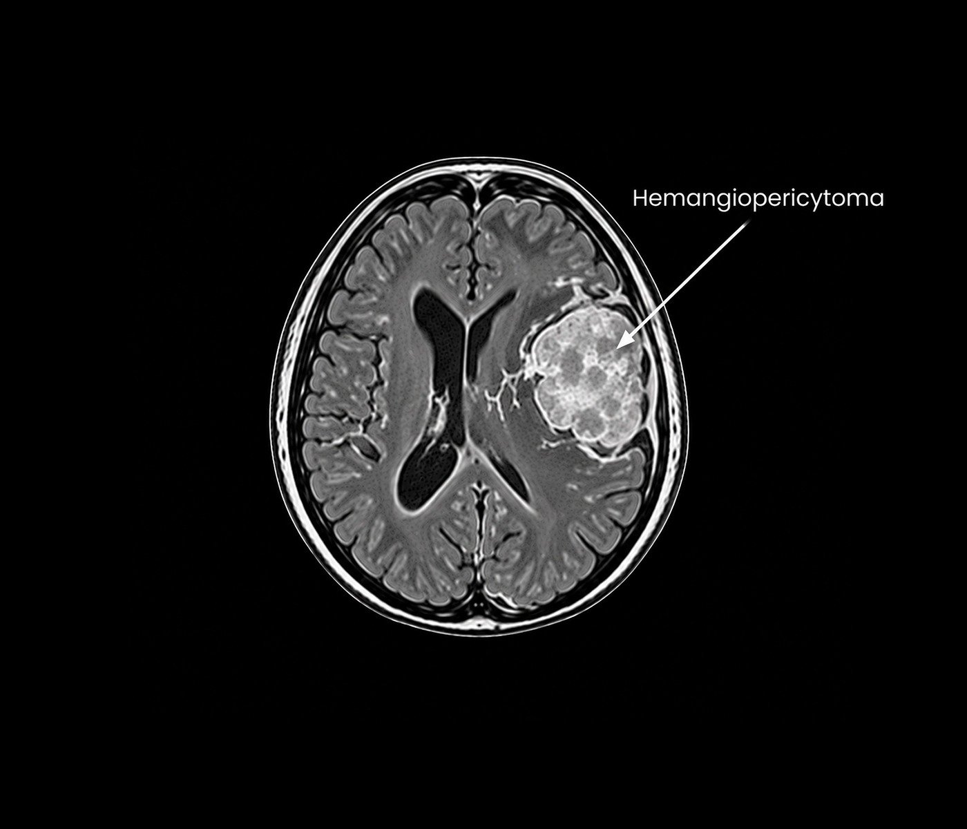 Hemangiopericytoma