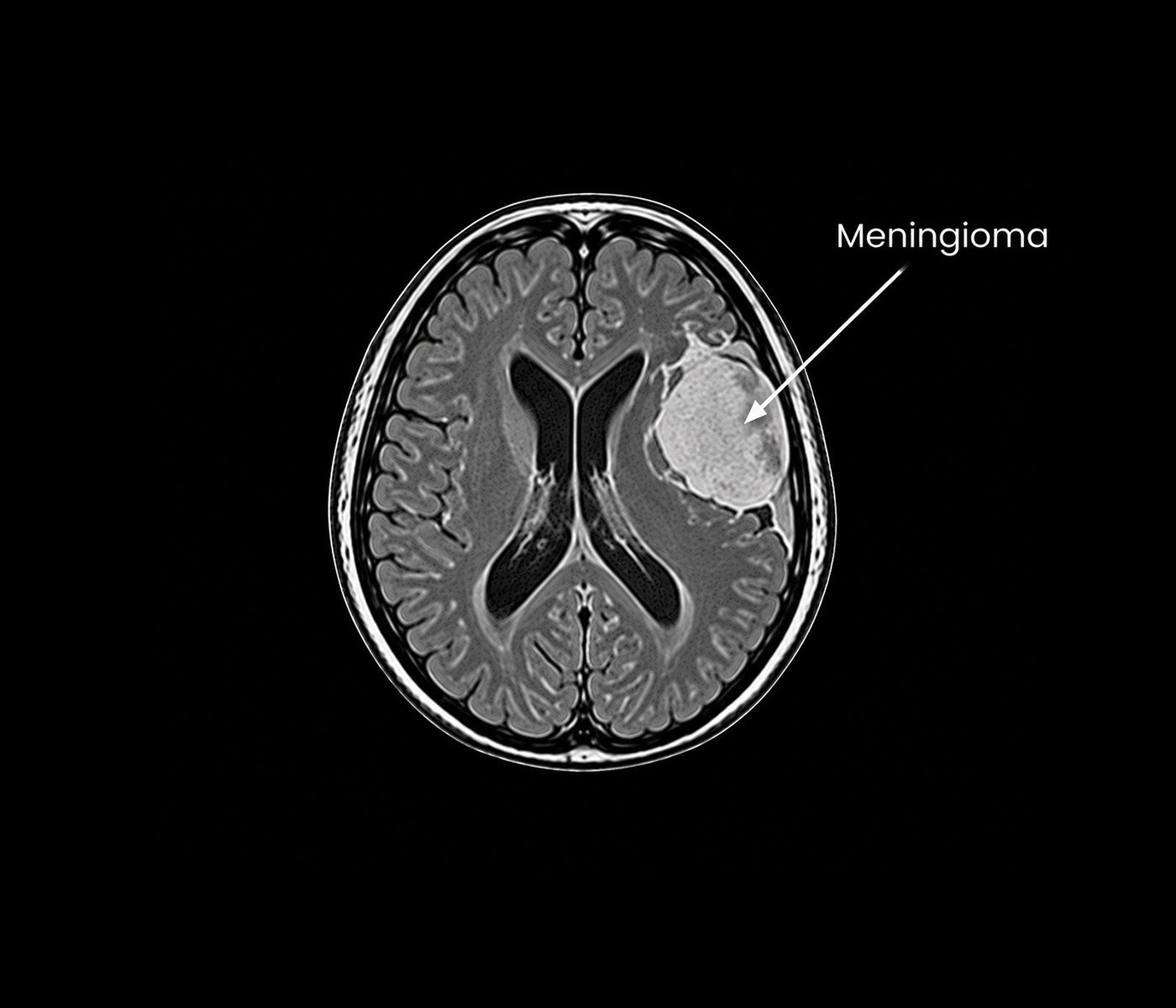 Meningioma