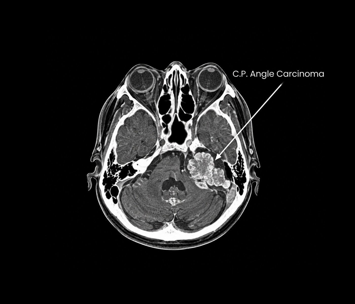 Cerebellopontine Angle Carcinoma