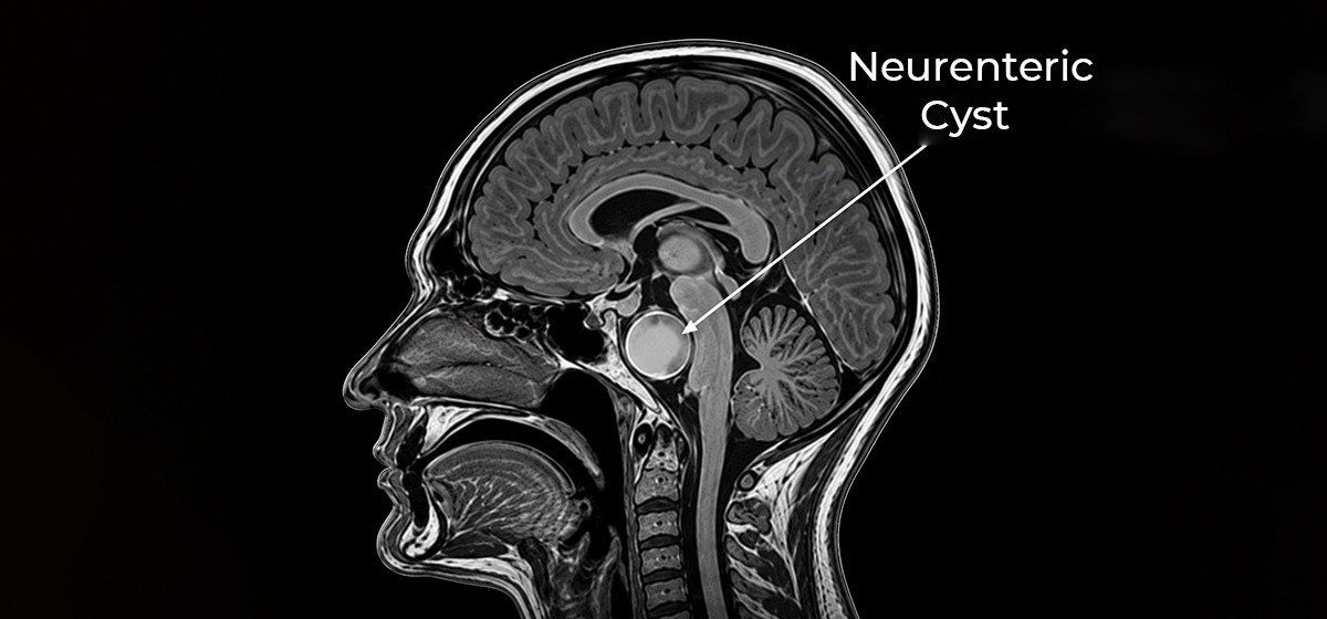 Neurenteric Cyst