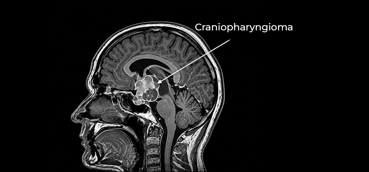 Craniopharyngioma