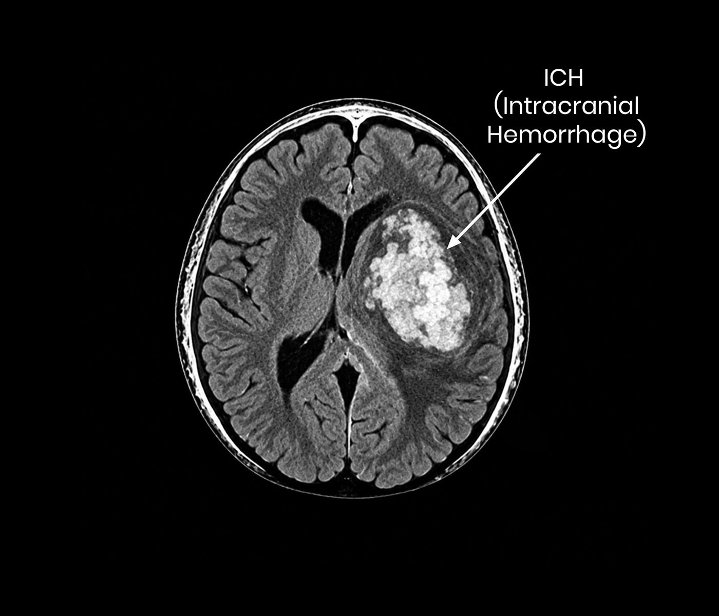 Intracranial Hemorrhage